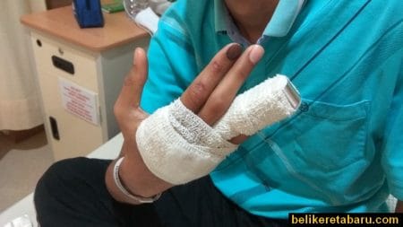Patah jari akibat dari kemalangan motosikal dengan kereta
